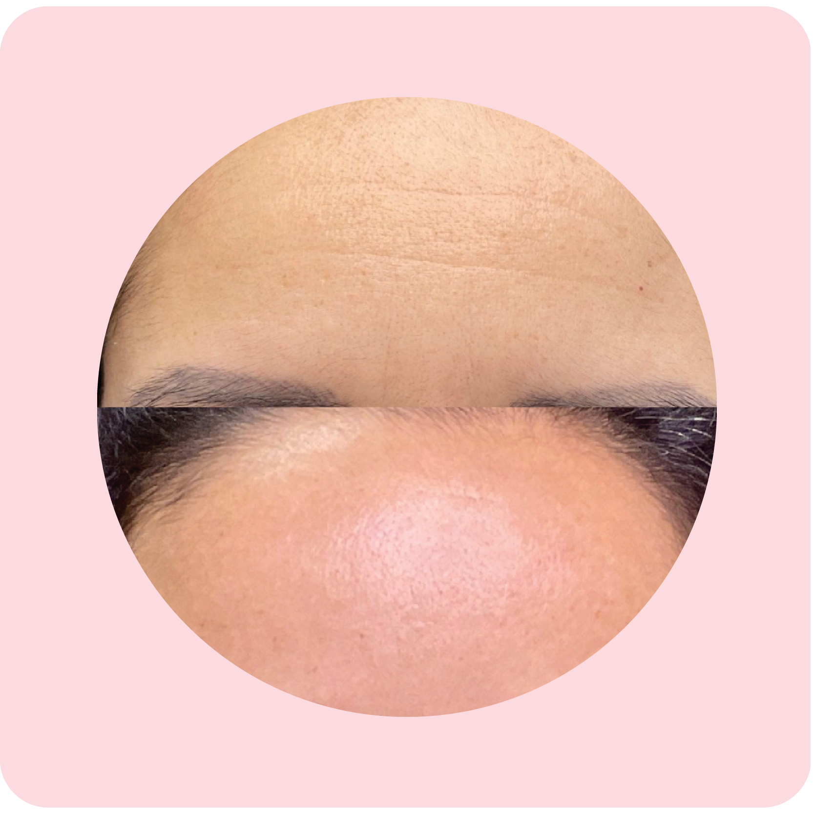 Before and after Botox treatment showing reduced facial wrinkles | Crawford Cosmetics