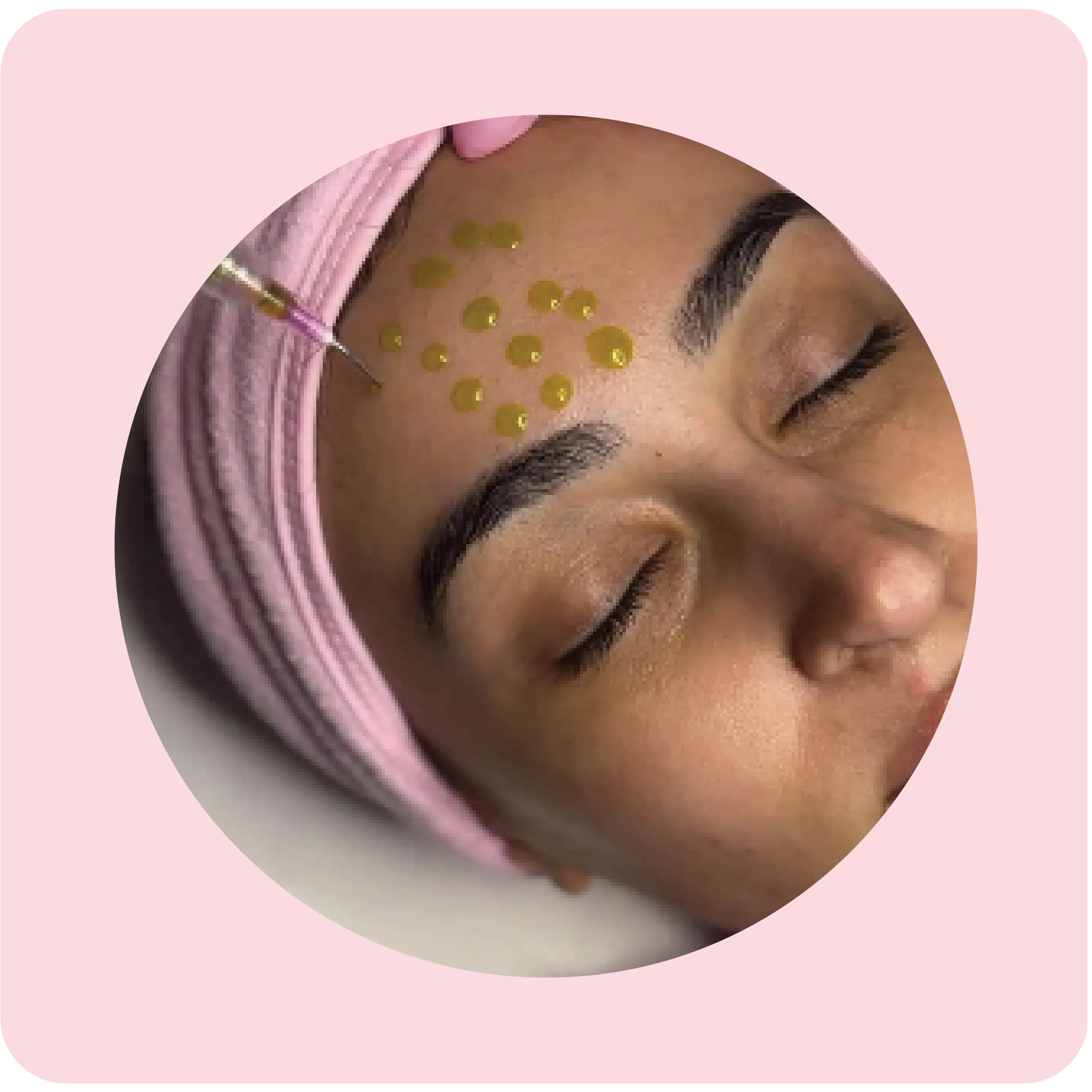 Woman receiving a chemical peel treatment for skin resurfacing | Crawford Cosmetics