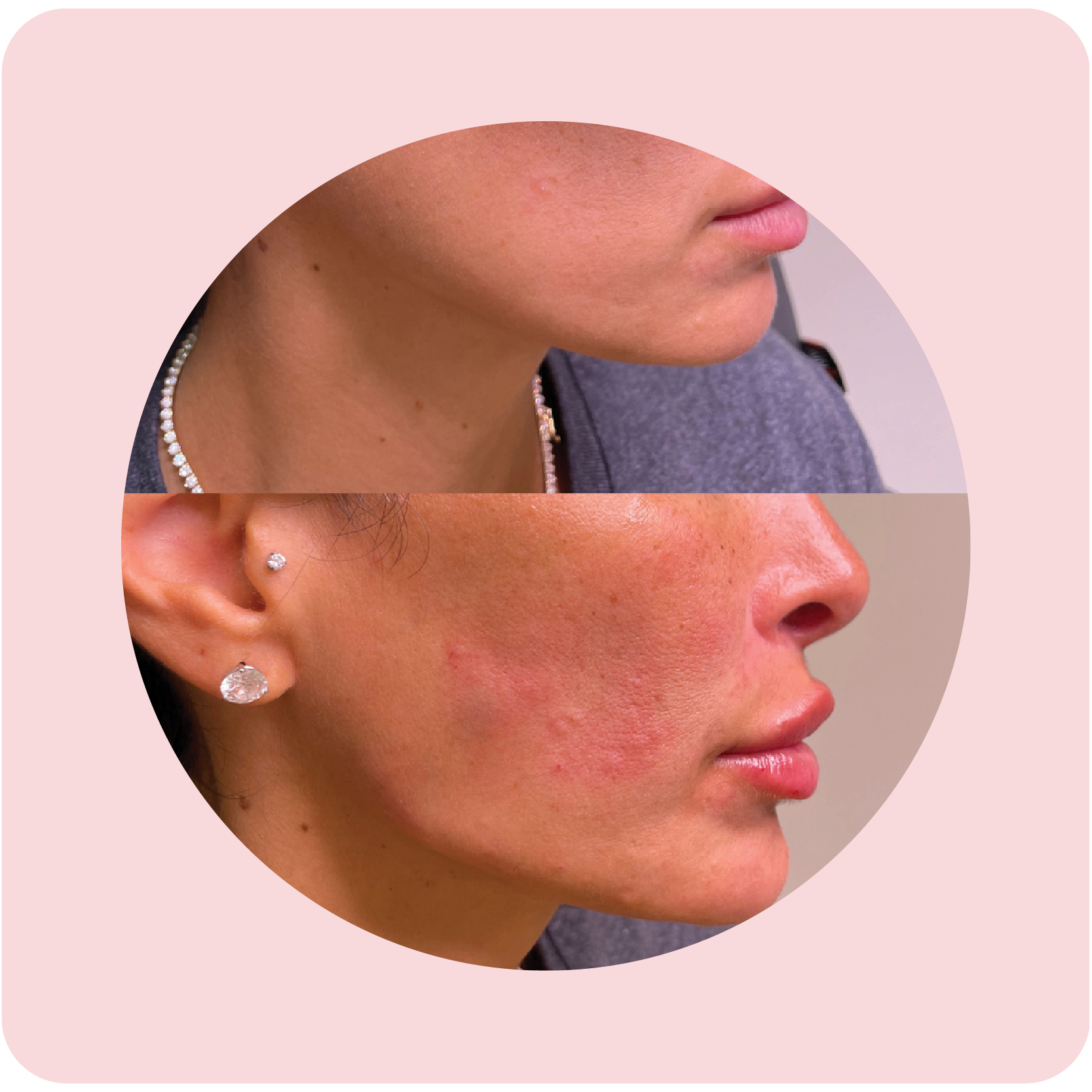 Before and after chin filler treatment showing improved chin definition | Crawford Cosmetics