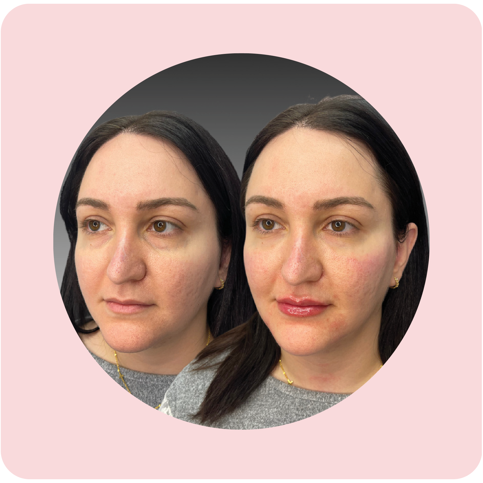 Before and after facial balancing treatment showing improved facial symmetry | Crawford Cosmetics