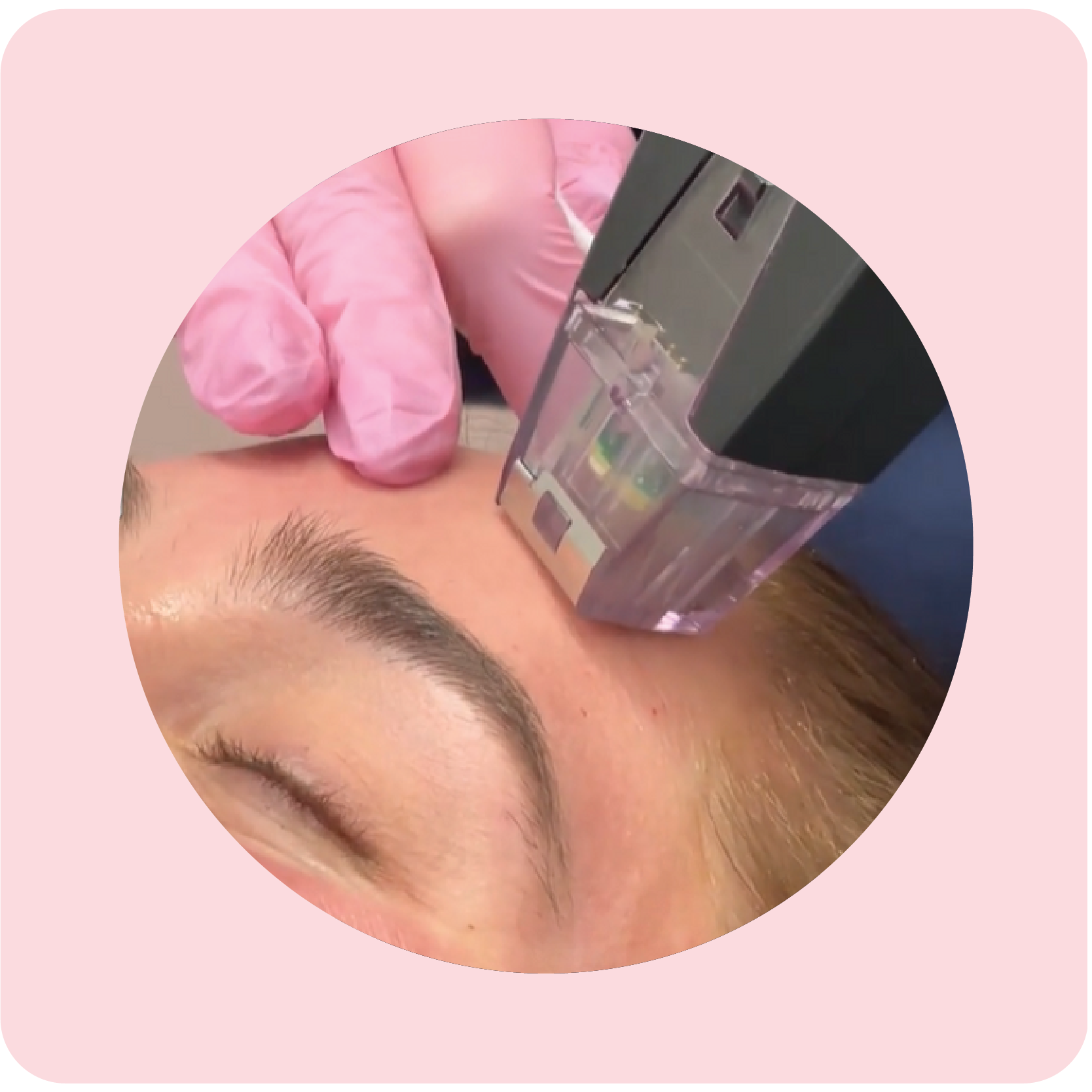 Woman receiving Morpheus skin remodeling treatment | Crawford Cosmetics