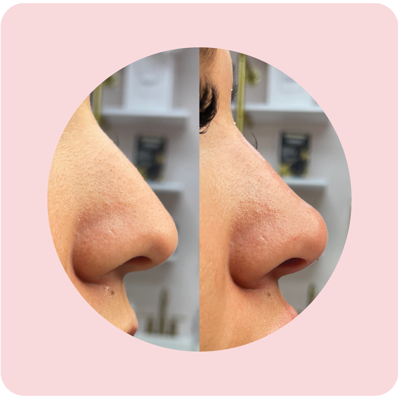 Before and after nose filler results showing refined nasal contour | Crawford Cosmetics