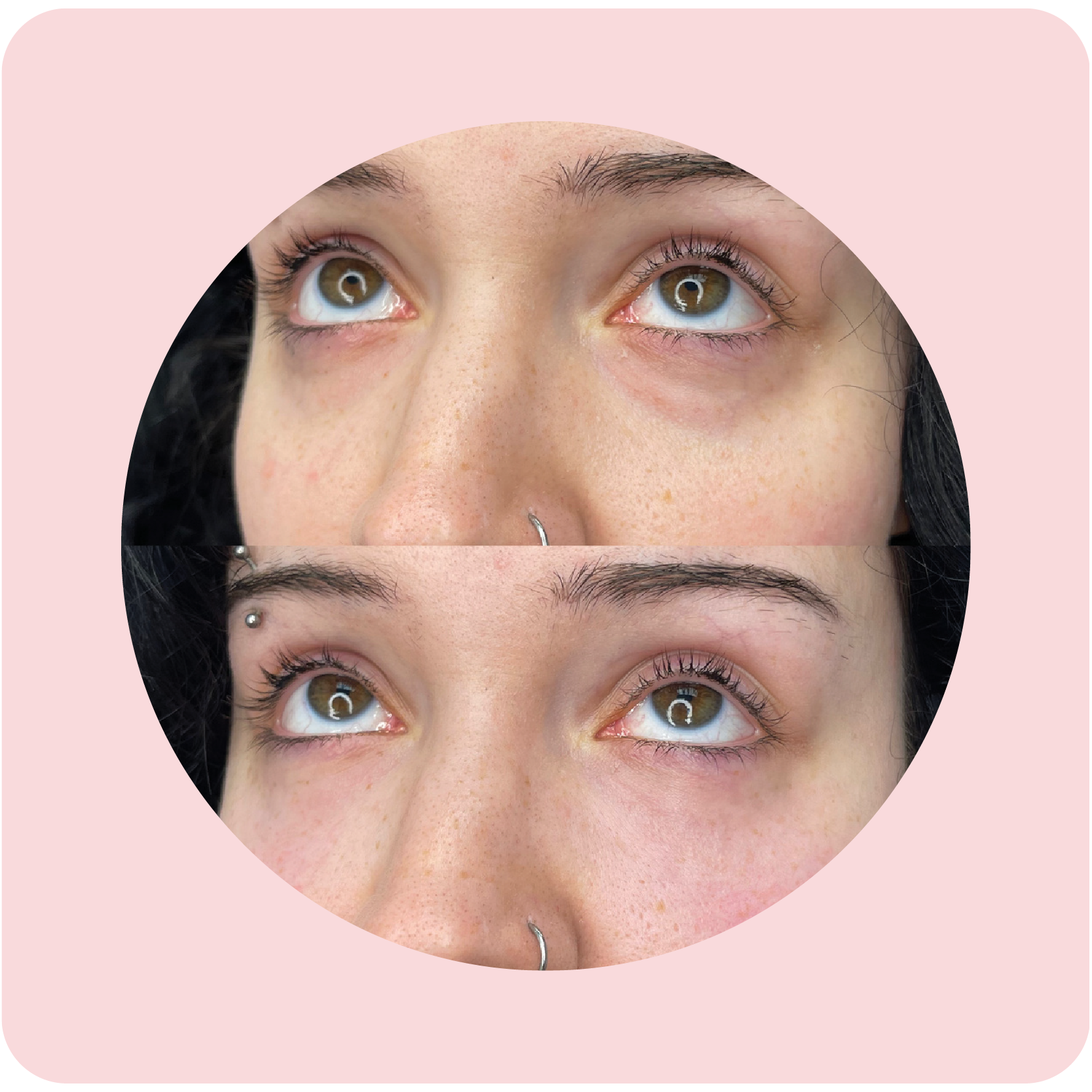Before and after undereye filler results showing reduced hollows | Crawford Cosmetics