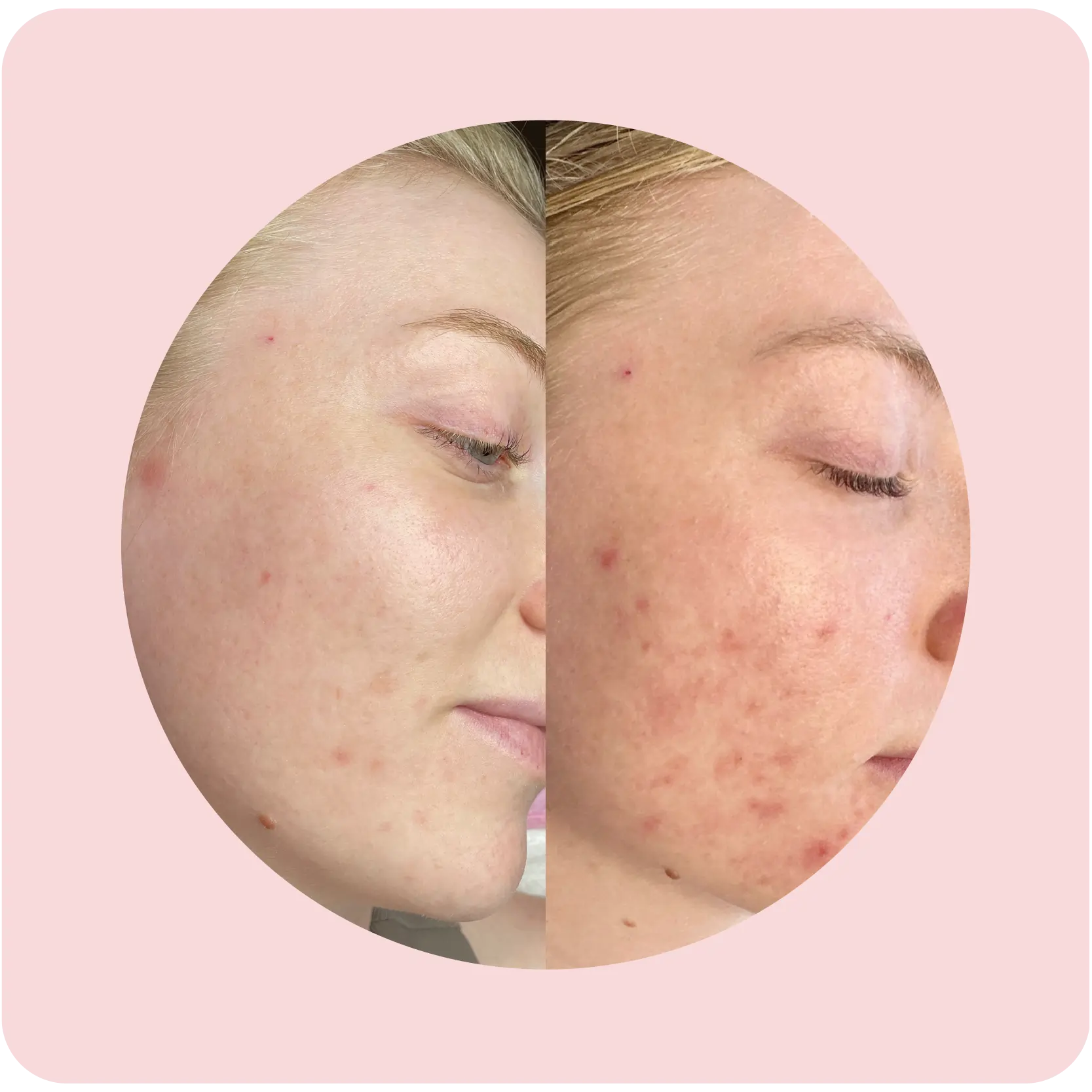 Before and after Acne Bootcamp results showing reduced acne and smoother skin | Crawford Cosmetics