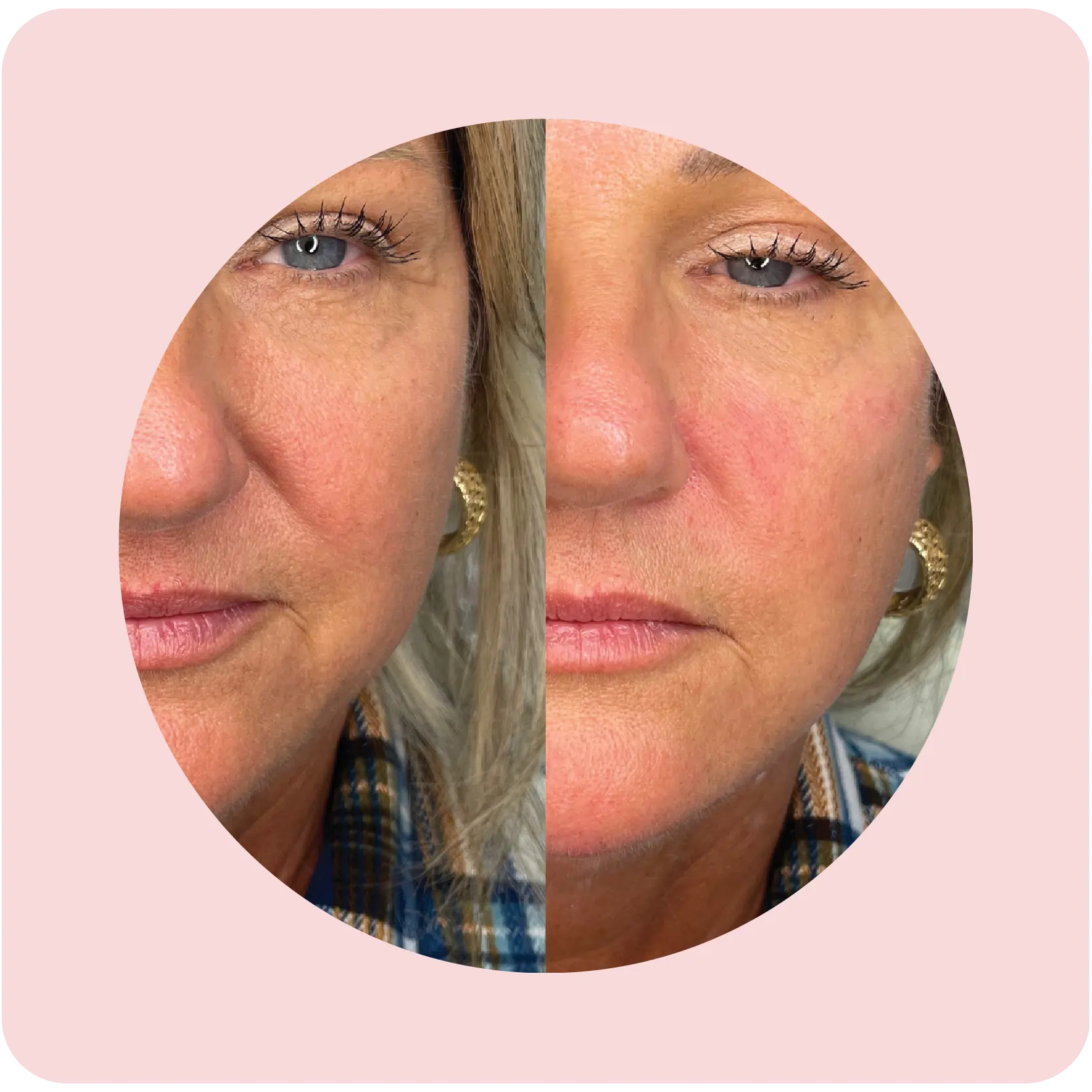 Before and after facial filler treatment showing improved volume | Crawford Cosmetics