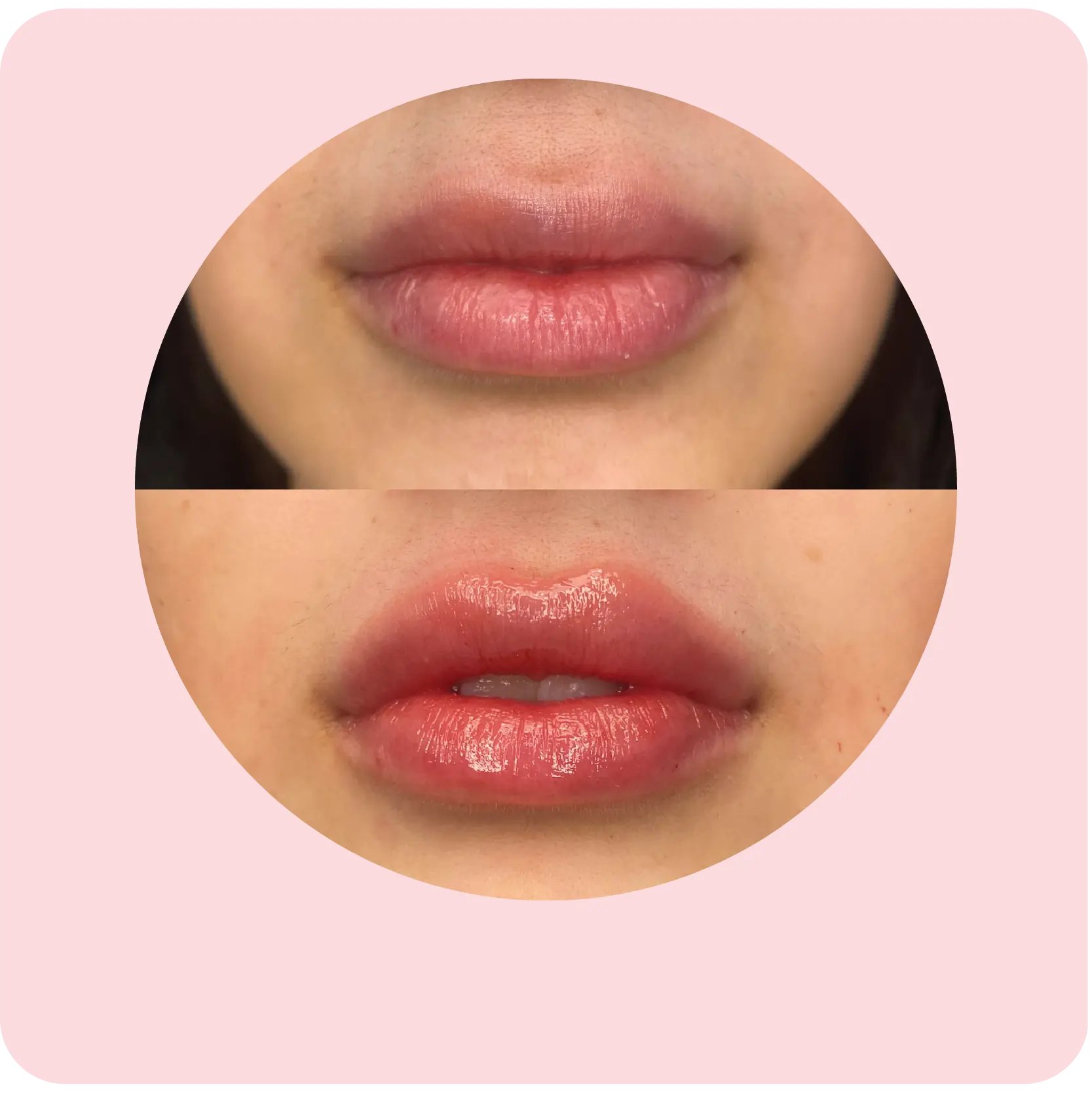 Before and after lip injection results showing fuller lips | Crawford Cosmetics
