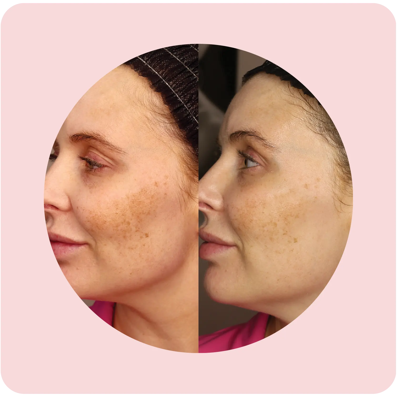 Before and after Melasma Bootcamp results showing reduced pigmentation | Crawford Cosmetics