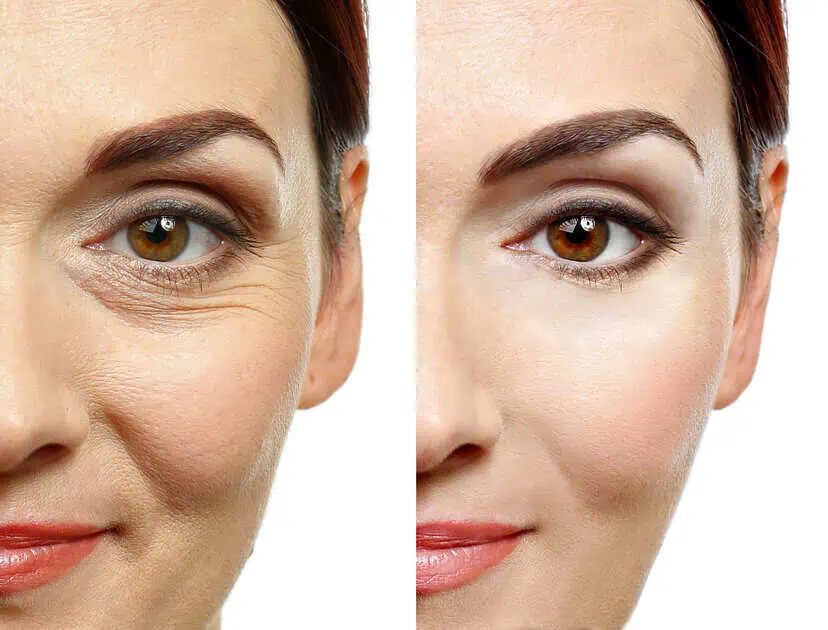 PRP undereye treatment, eye bags treatment, best treatment for under eye wrinkles, non-surgical under eye rejuvenation, PRP Injections in MI
